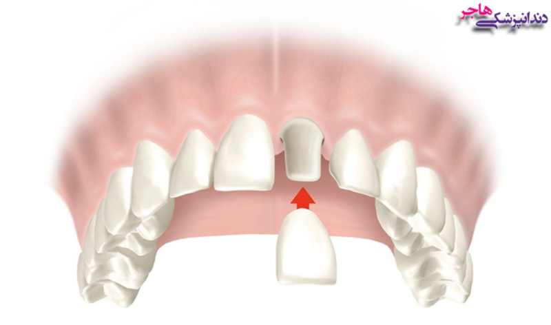 ). از روکش برای ترمیم دندان، تغییر شکل، رنگ، اندازه و نیز افزایش استحکام دندان استفاده میشود. 